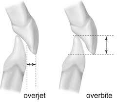 difference between overjet and overbite