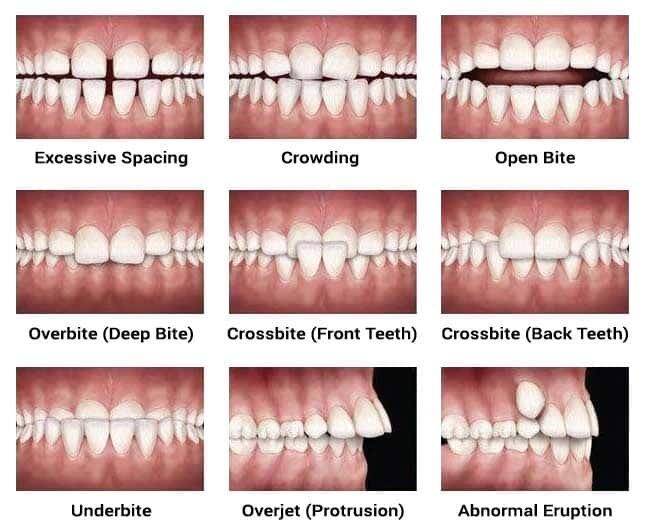The differences between common bite types, such as an overbite and an underbite.