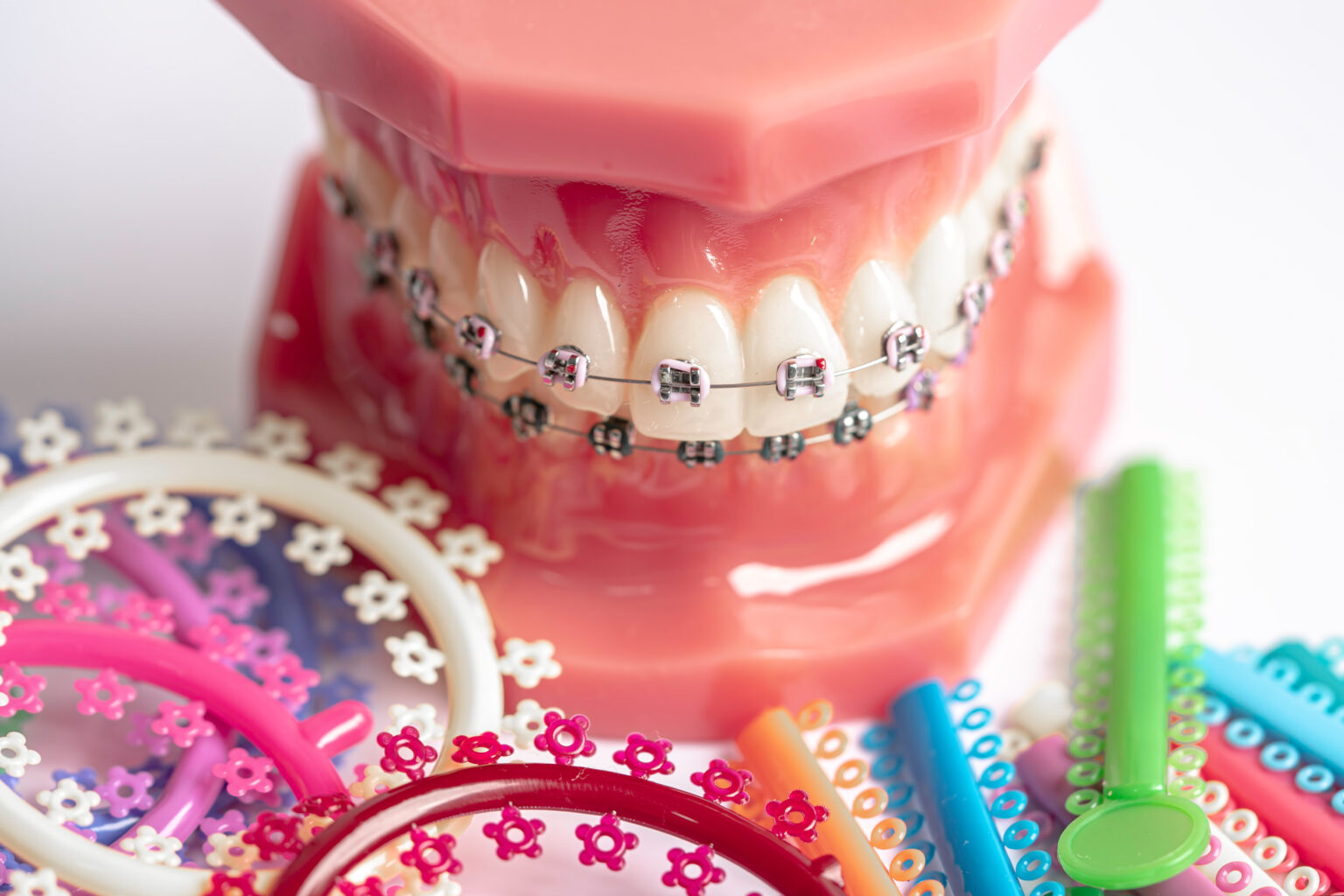 Module Colours Ortho What Are the Best Braces Colours? A Complete Guide for All Ages