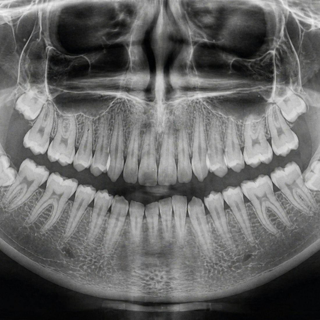 Panoramic dental radiograph showing the teeth and jaws